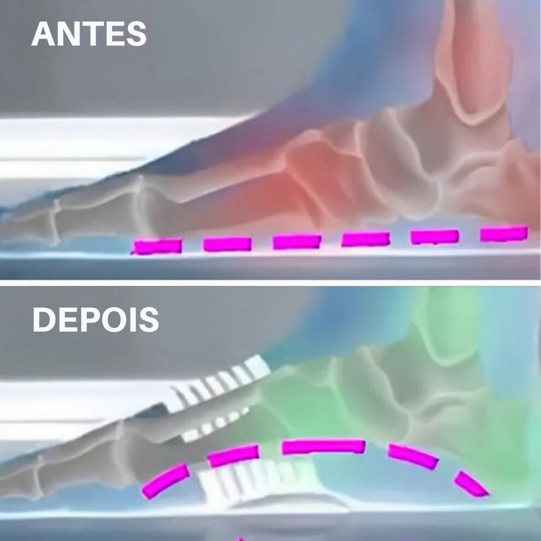 Faixa de Suporte para Arco - OrtoFlex - Alívio Plantar